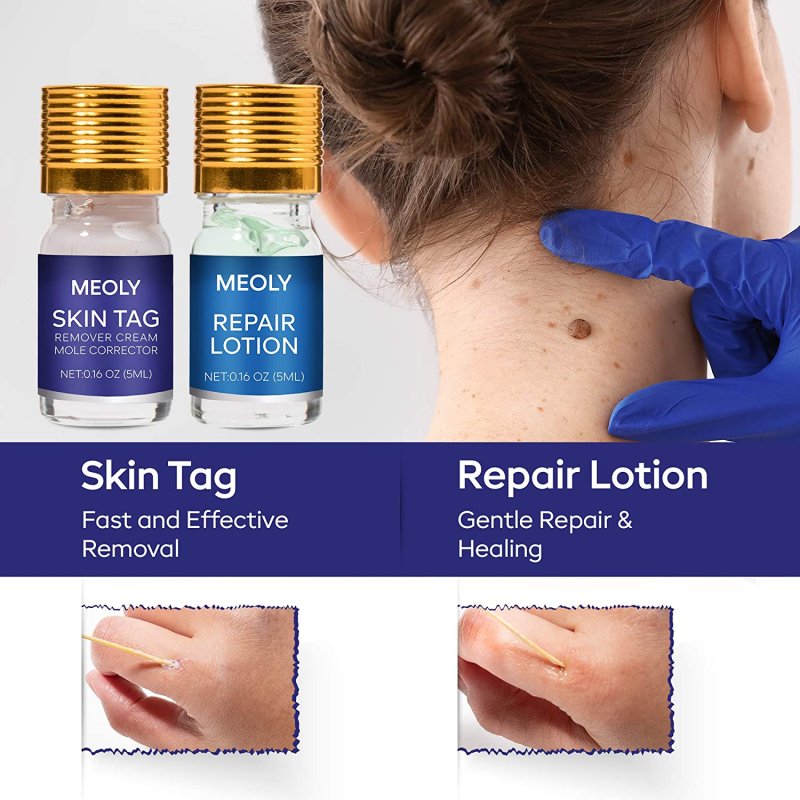 MEOLY MOLE REMOVER AND SKIN TAG REMOVAL REPAIR LOTION SET
