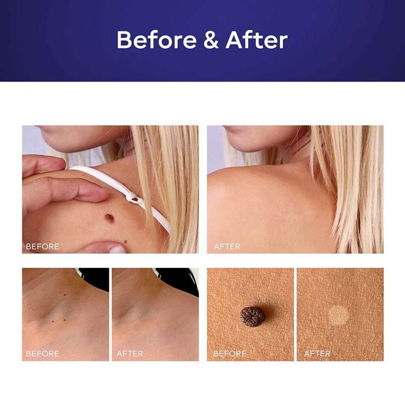 MEOLY MOLE REMOVER AND SKIN TAG REMOVAL REPAIR LOTION SET