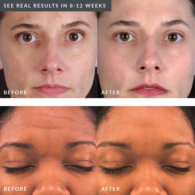 PMD BEAUTY PERSONAL MICRODERM ELITE PRO