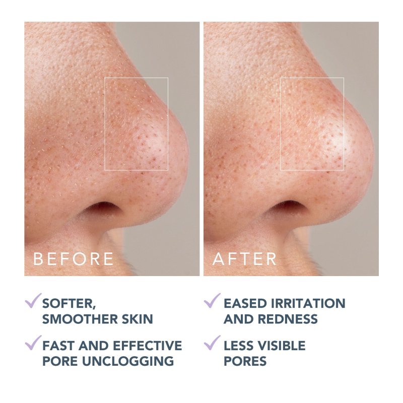 FOREO KIWI ACTIVE PORE AND BLACKHEAD MASK FOR CLEAR SKIN