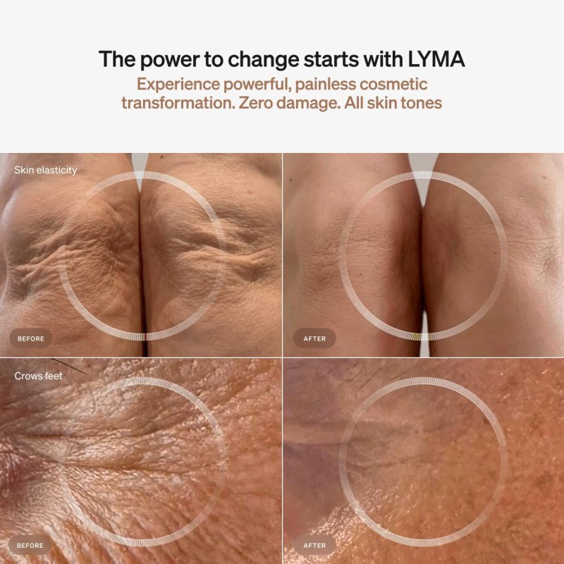 LYMA LIFE B0DB3WWJD8 CAN BE REWRITTEN AS "LYMA LIFE ADVANCED WELLNESS SUPPLEMENT