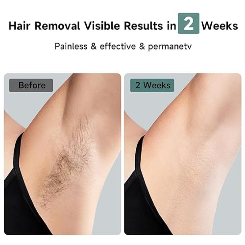 JOVS LASER HAIR REMOVAL DEVICE WITH SAPPHIRE ICE COOLING, 3-IN-1 SKIN REJUVENATION 8 MODES