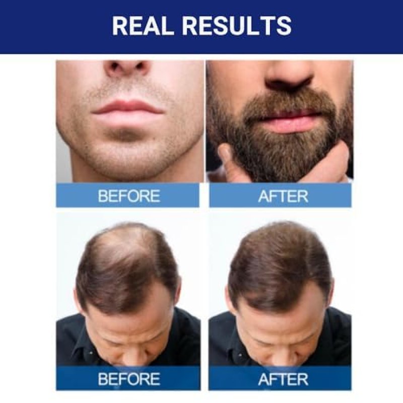 KIRKLAND SIGNATURE MINOXIDIL 5 EXTRA STRENGTH HAIR REGROWTH FOR MEN, 1-MONTH SUPPLY