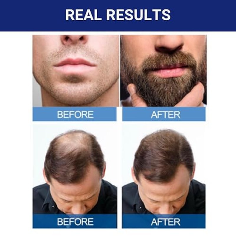 KIRKLAND SIGNATURE MINOXIDIL 5 FOR MEN HAIR REGROWTH - 1 MONTH SUPPLY, EFFECTIVE TREATMENT