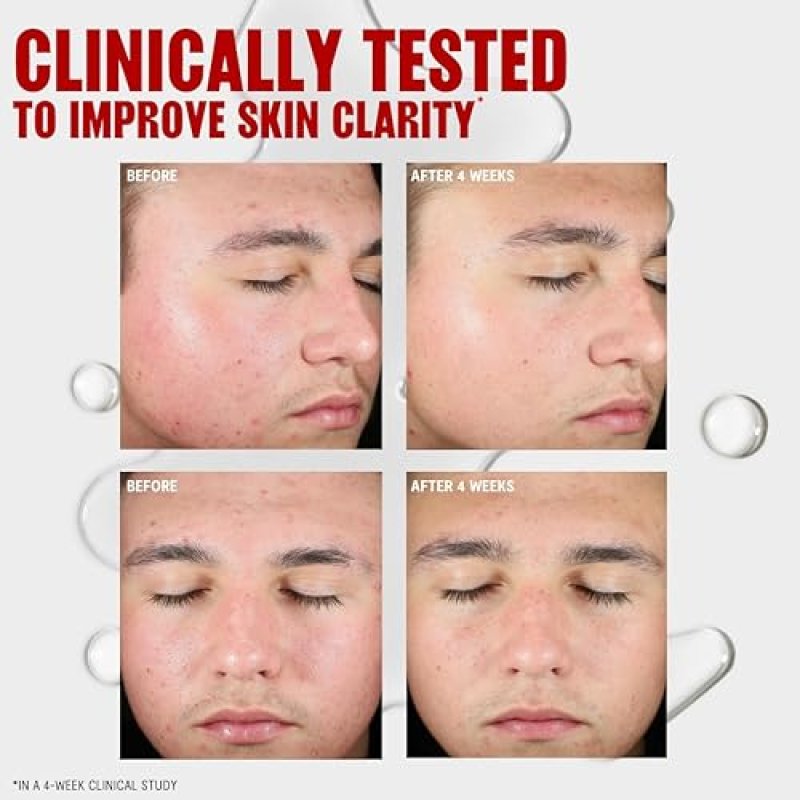 THAYERS 2 SALICYLIC ACID BLEMISH CLEARING TONER FOR ACNE, SOOTHING NON-STRIPPING SKIN, 12OZ