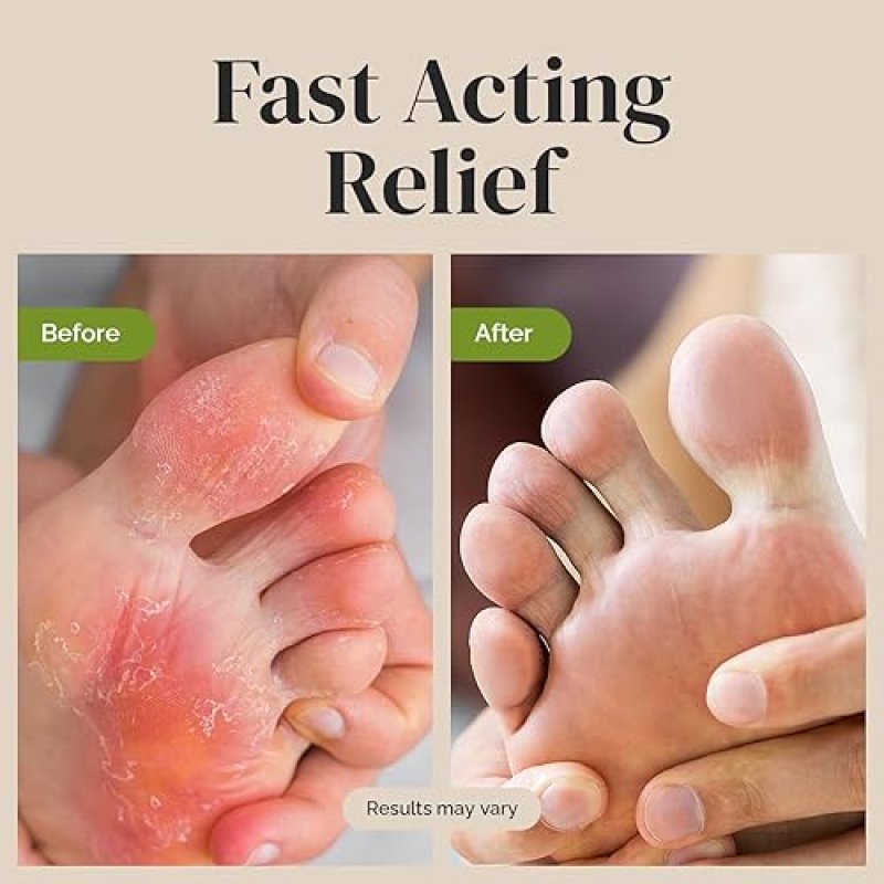 PURIYA EXTRA-STRENGTH ANTIFUNGAL CREAM FOR ATHLETE S FOOT, JOCK ITCH RINGWORM, ITCH RELIEF