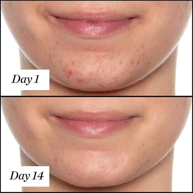 SUNDAY RILEY U.F.O. SALICYLIC ACID TEA TREE FACE OIL FOR ACNE TREATMENT ULTRA-CLARIFYING CARE