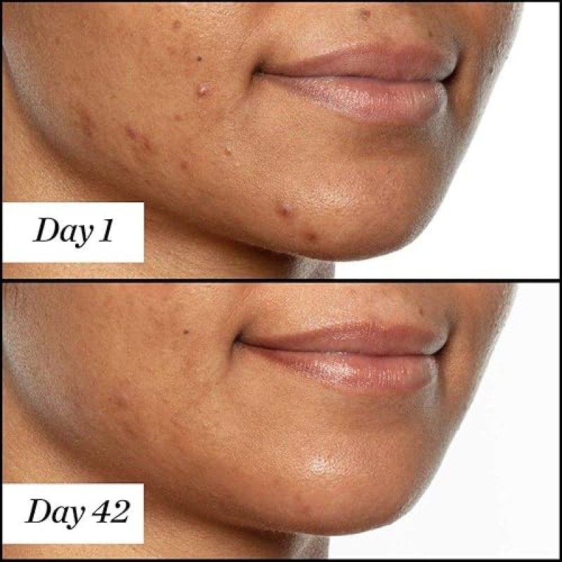SUNDAY RILEY U.F.O. SALICYLIC ACID TEA TREE FACE OIL FOR ACNE TREATMENT ULTRA-CLARIFYING CARE