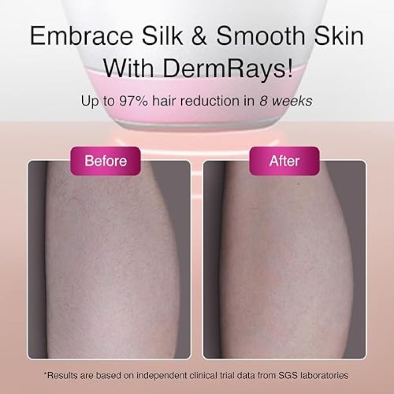 DERMRAYS 1064NM DIODE LASER HAIR REMOVAL FOR DARK MELANATED SKIN, PERMANENT REDUCTION