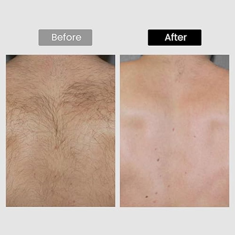 DERMRAYS 810NM DIODE LASER HAIR REMOVAL DEVICE FOR SKIN TONE 1-5 PERMANENT HOME HAIR REDUCTION