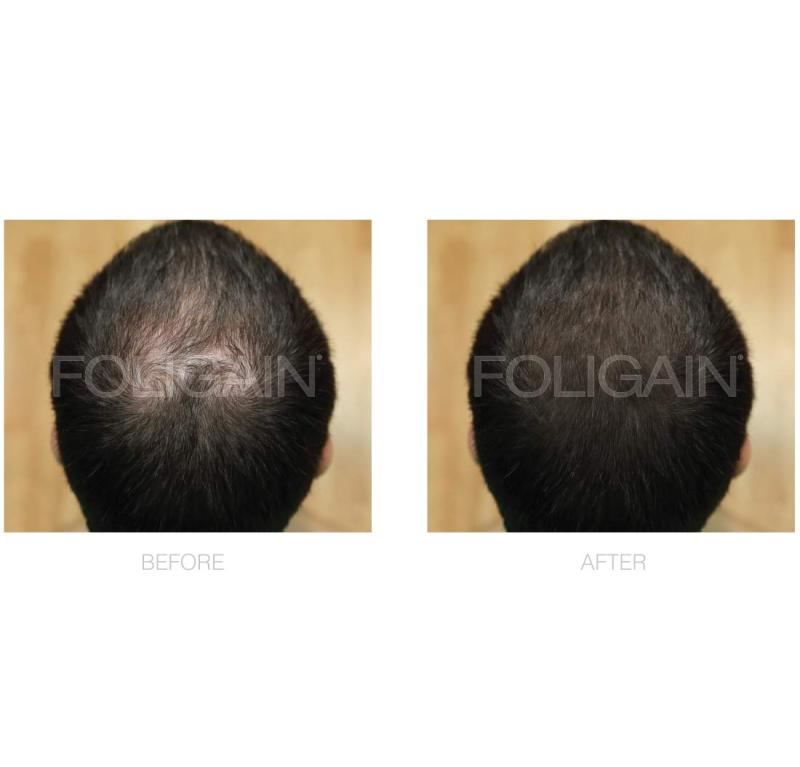 FOLIGAIN MINOXIDIL 5% HAIR REGROWTH FOAM FOR MEN 6 MONTH SUPPLY