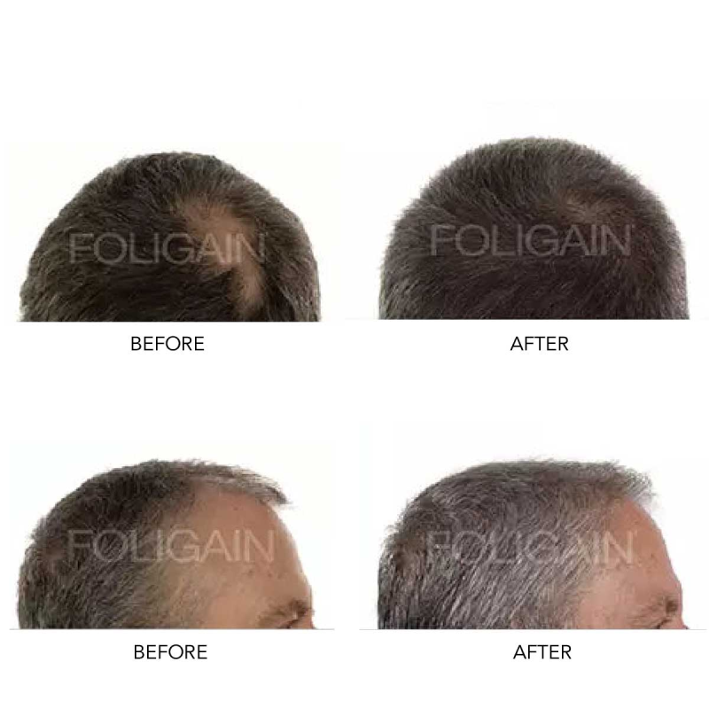 FOLIGAIN MEN'S HAIR REGROWTH KIT