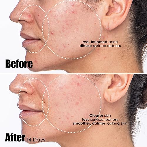 SUNDAY RILEY PEACEKEEPER ACNE TREATMENT SERUM WITH AZELAIC SALICYLIC ACID FOR CLEAR SKIN