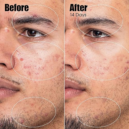 SUNDAY RILEY PEACEKEEPER ACNE TREATMENT SERUM WITH AZELAIC SALICYLIC ACID FOR CLEAR SKIN