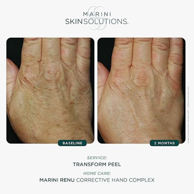 MARINI SKINSOLUTIONS RENU HAND COMPLEX WITH RETINOL VITAMIN C FOR WRINKLES TEXTURE - 1 OZ