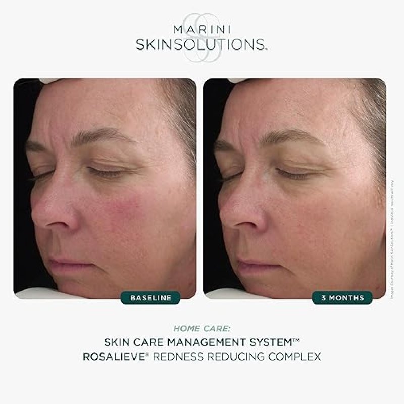 MARINI SKINSOLUTIONS ROSALIEVE REDNESS REDUCING FACE LOTION WITH AZELAIC ACID PEPTIDES